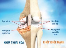 Tập Thể Dục Ngăn Chặn Sự Thoái Hóa Sụn Do Viêm Xương Khớp
