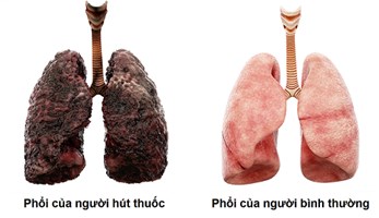 Điều gì gây ra ung thư phổi ở những người không hút thuốc
