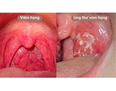 Ung thư vòm họng giai đoạn đầu: Dấu hiệu, chẩn đoán, điều trị