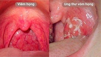 Ung thư vòm họng giai đoạn đầu: Dấu hiệu, chẩn đoán, điều trị
